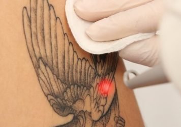 Tattoo-Removal-Treatment.jpg